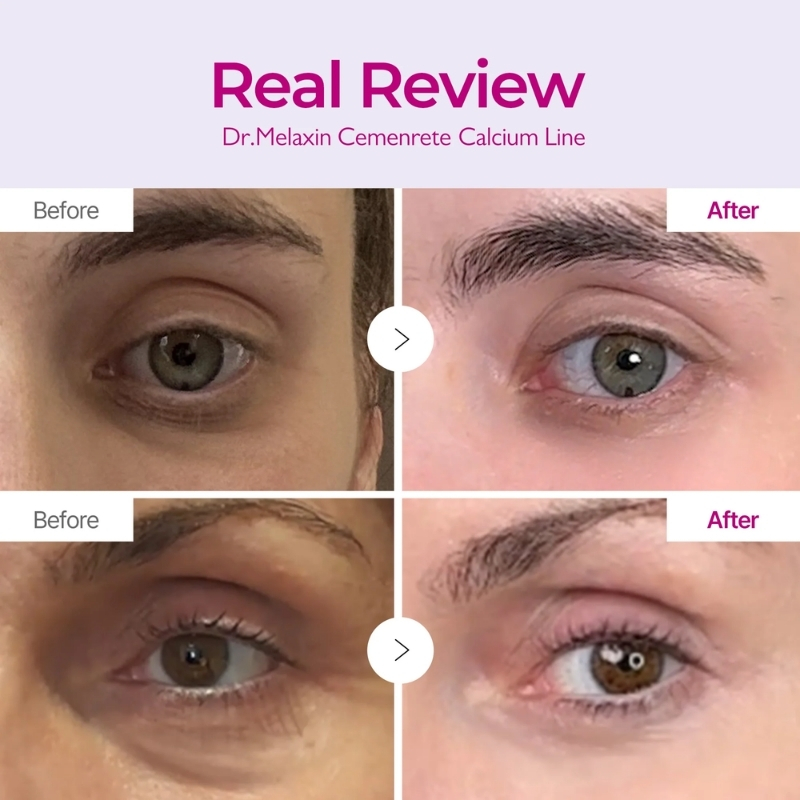 Dr Melaxin Cemenrete Calcium Intense Cream Use of skin calcium REBORNIC patented raw material - Up to 127% improvement in the volume of sunken areas under the eyes Completed clinical test - 30ml large capacity, can be generously applied to the entire area around the eyes and under the eyes