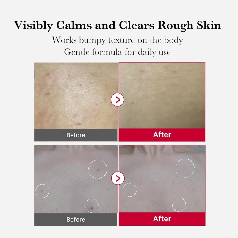 Comparison collage showing before and after skin texture: rough, bumpy skin on the left panels and smoother skin on the right panels, with 'Before' and 'After' labels visible.