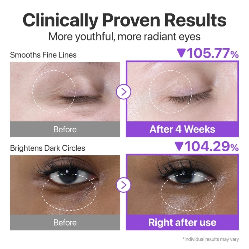 Skincare comparison: before and after eye area, showing smoother lines and brighter under-eye skin after use. (Two-panel image with Before on left and After on right)