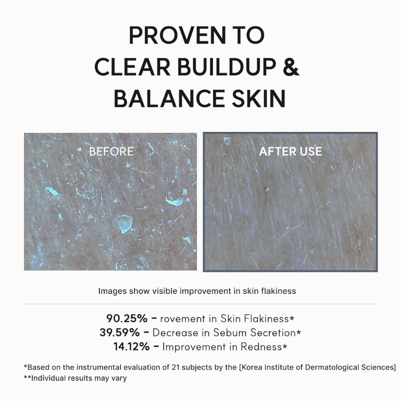 Before vs after skin treatment: less flakiness and smoother texture in the after image.