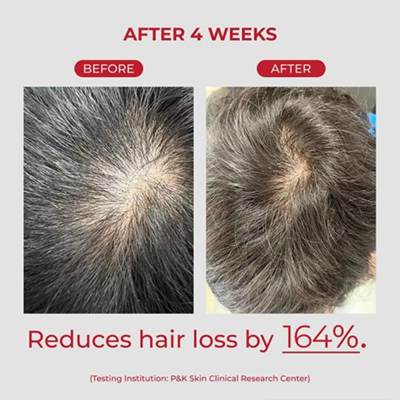 Before and after scalp photos after four weeks, showing hair regrowth; text reads Reduces hair loss by 164%.